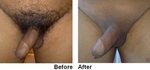 Male genital waxing